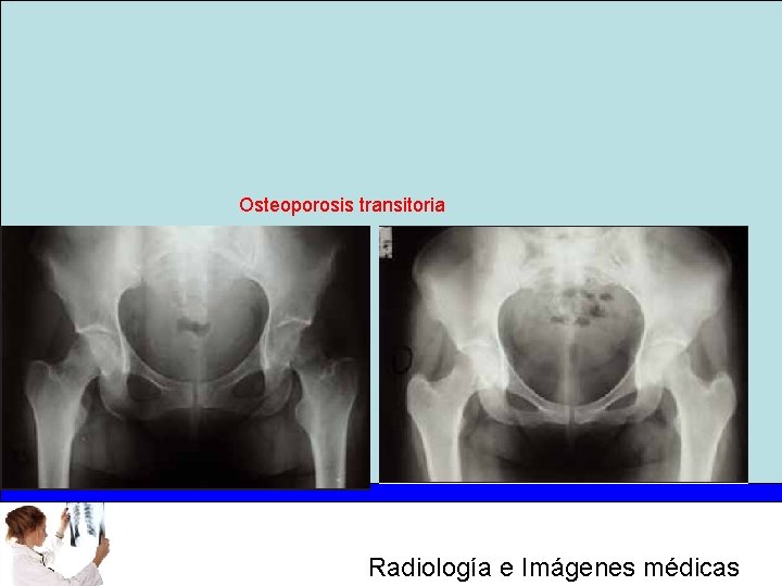 Osteoporosis transitoria Radiología e Imágenes médicas 