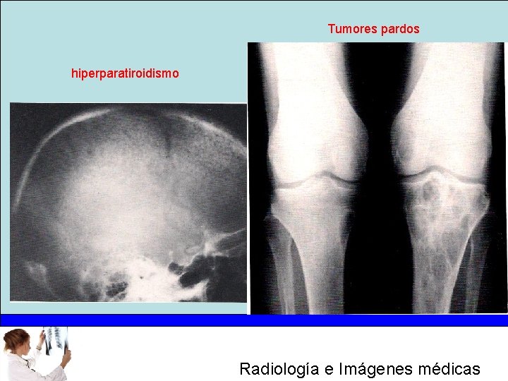 Tumores pardos hiperparatiroidismo Radiología e Imágenes médicas 