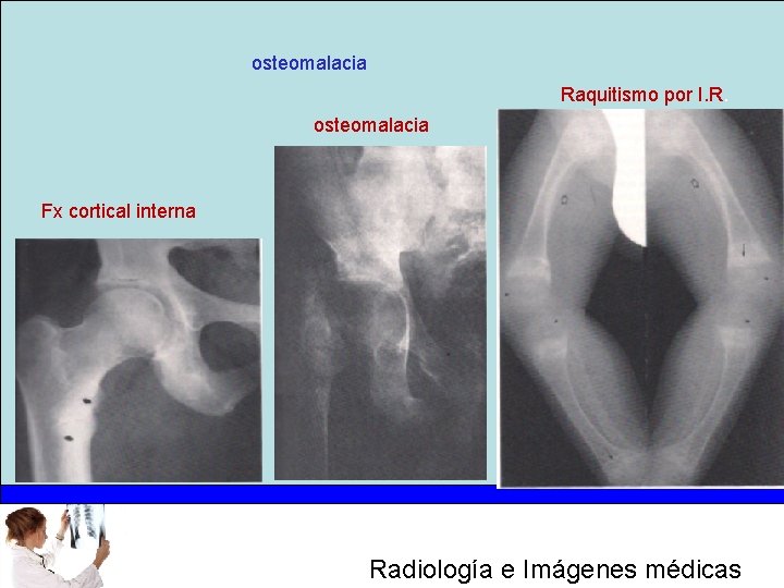 osteomalacia Raquitismo por I. R. osteomalacia Fx cortical interna Radiología e Imágenes médicas 