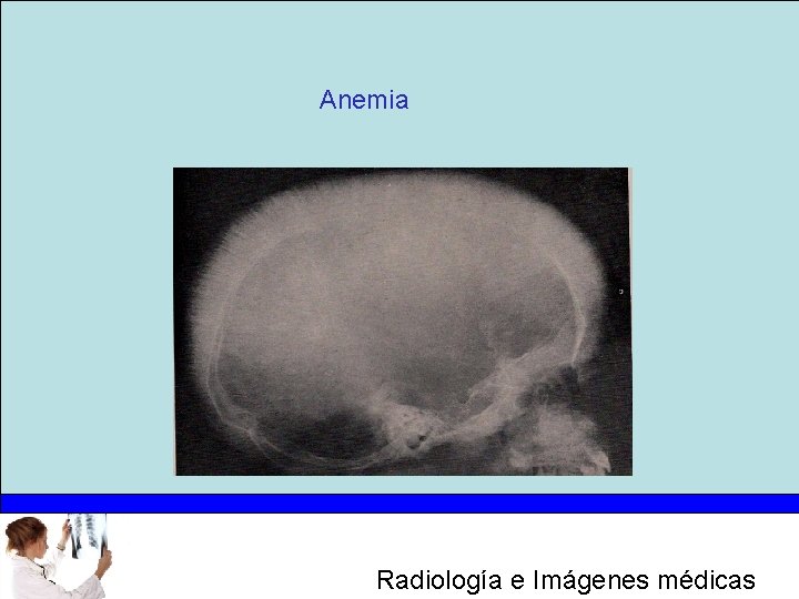 Anemia Radiología e Imágenes médicas 