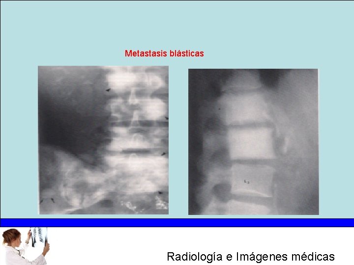 Metastasis blásticas Radiología e Imágenes médicas 