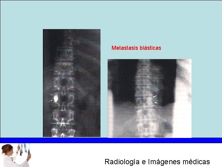 Metastasis blásticas Radiología e Imágenes médicas 