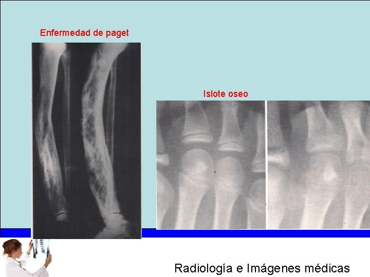 Enfermedad de paget Islote oseo Radiología e Imágenes médicas 