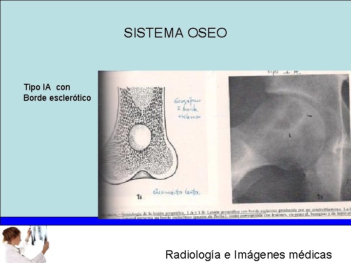 SISTEMA OSEO Tipo IA con Borde esclerótico Radiología e Imágenes médicas 