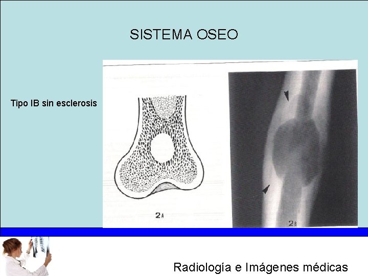 SISTEMA OSEO Tipo IB sin esclerosis Radiología e Imágenes médicas 