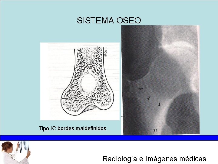 SISTEMA OSEO Tipo IC bordes maldefinidos Radiología e Imágenes médicas 