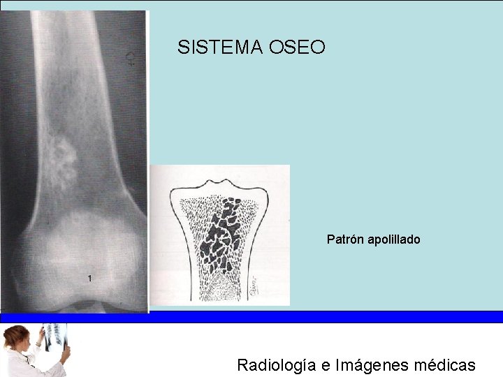 SISTEMA OSEO Patrón apolillado Radiología e Imágenes médicas 