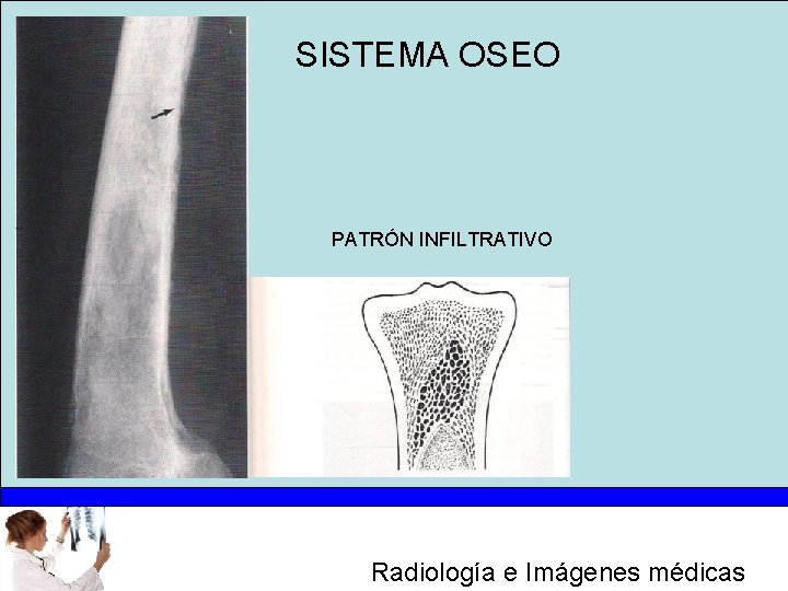 SISTEMA OSEO PATRÓN INFILTRATIVO Radiología e Imágenes médicas 
