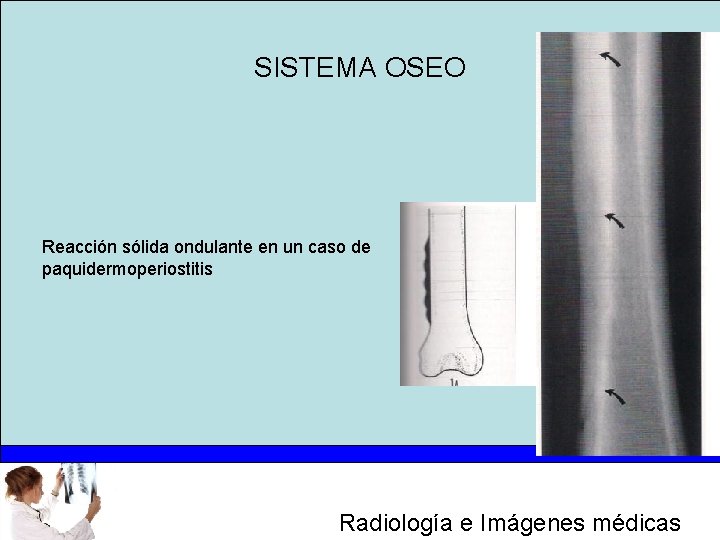 SISTEMA OSEO Reacción sólida ondulante en un caso de paquidermoperiostitis Radiología e Imágenes médicas