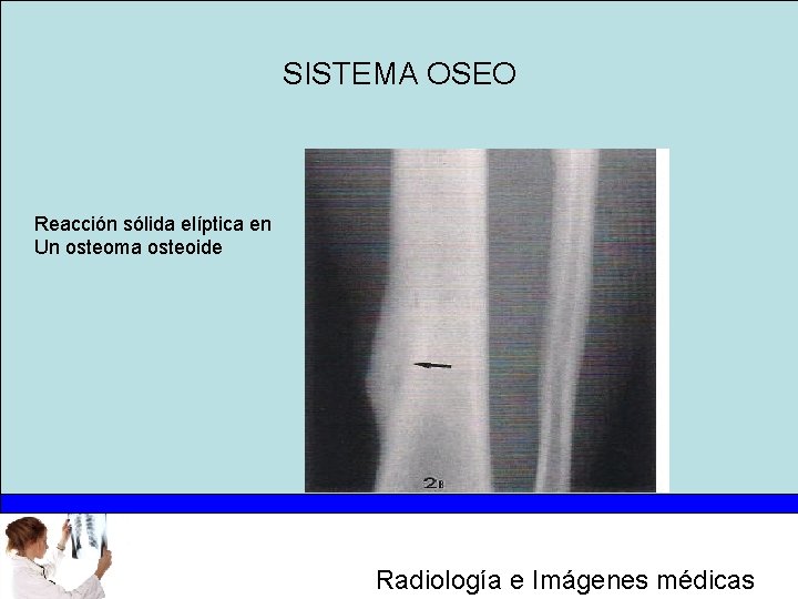 SISTEMA OSEO Reacción sólida elíptica en Un osteoma osteoide Radiología e Imágenes médicas 