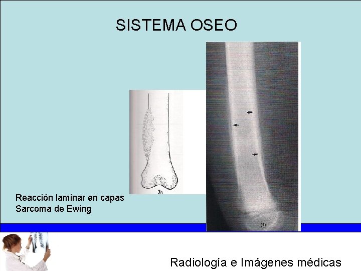 SISTEMA OSEO Reacción laminar en capas Sarcoma de Ewing Radiología e Imágenes médicas 