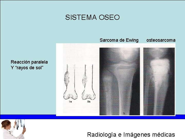 SISTEMA OSEO Sarcoma de Ewing osteosarcoma Reacción paralela Y “rayos de sol” Radiología e