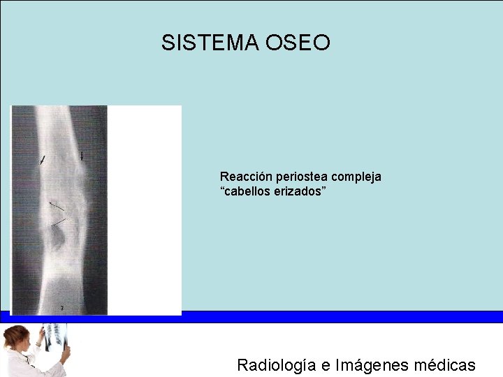 SISTEMA OSEO Reacción periostea compleja “cabellos erizados” Radiología e Imágenes médicas 