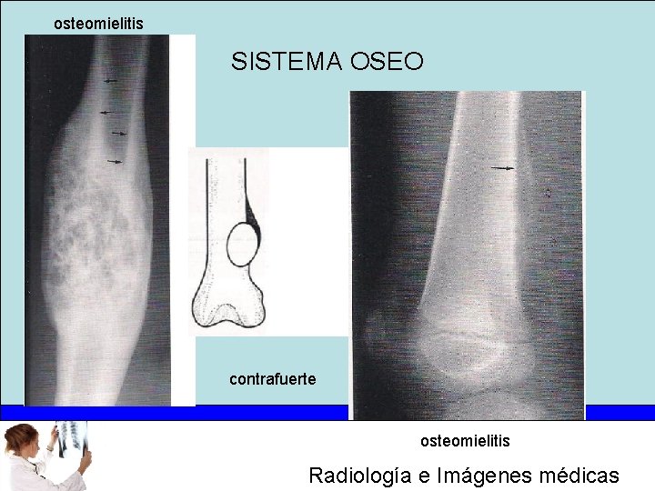 osteomielitis SISTEMA OSEO contrafuerte osteomielitis Radiología e Imágenes médicas 