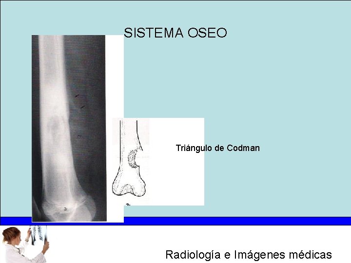 SISTEMA OSEO Triángulo de Codman Radiología e Imágenes médicas 