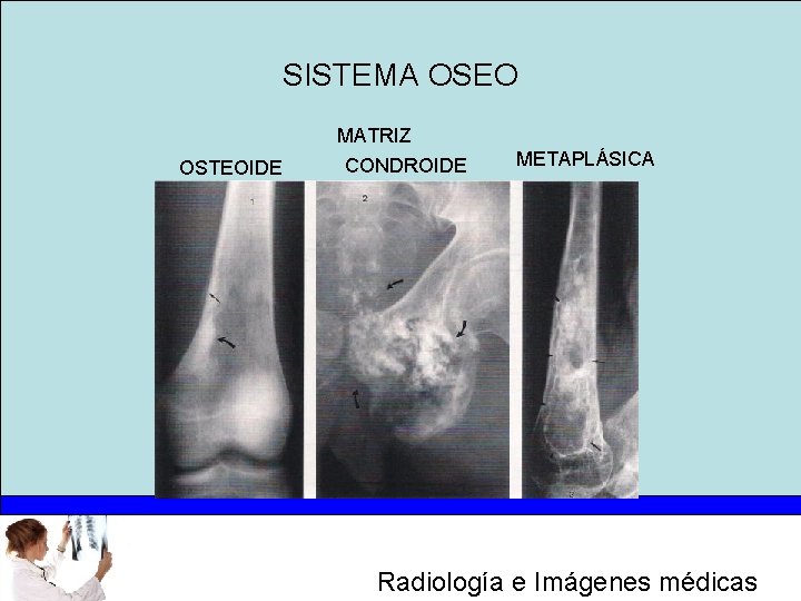SISTEMA OSEO OSTEOIDE MATRIZ CONDROIDE METAPLÁSICA Radiología e Imágenes médicas 