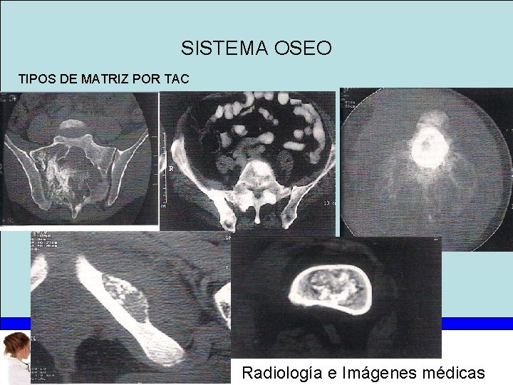 SISTEMA OSEO TIPOS DE MATRIZ POR TAC Radiología e Imágenes médicas 