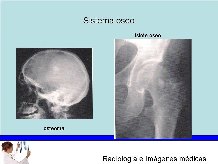 Sistema oseo Islote oseo osteoma Radiología e Imágenes médicas 