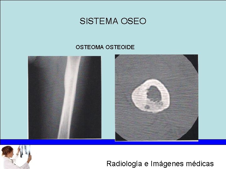 SISTEMA OSEO OSTEOMA OSTEOIDE Radiología e Imágenes médicas 