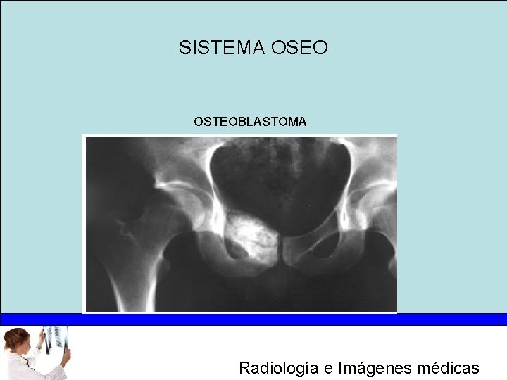 SISTEMA OSEO OSTEOBLASTOMA Radiología e Imágenes médicas 