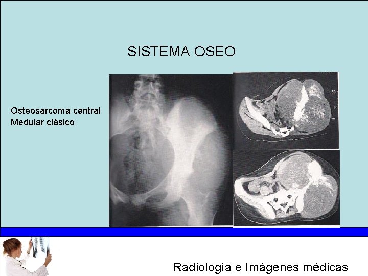 SISTEMA OSEO Osteosarcoma central Medular clásico Radiología e Imágenes médicas 
