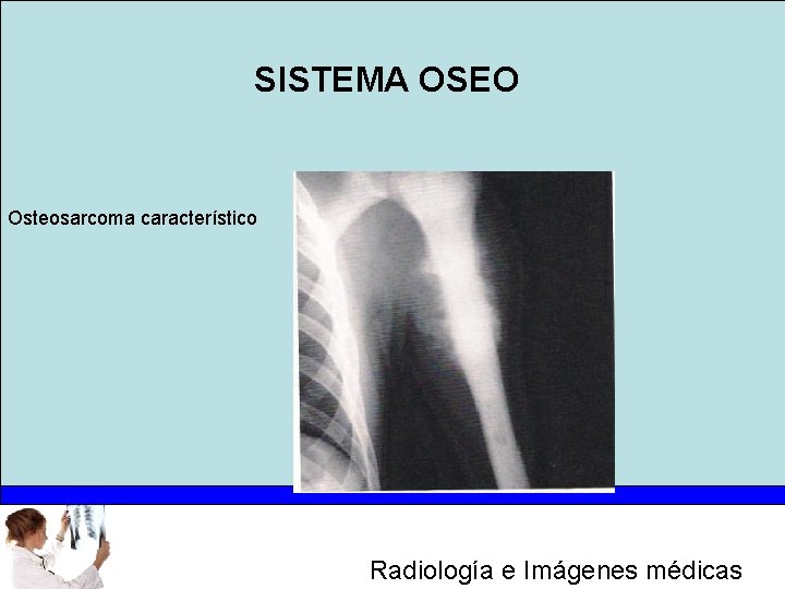 SISTEMA OSEO Osteosarcoma característico Radiología e Imágenes médicas 