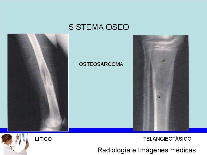 SISTEMA OSEO OSTEOSARCOMA LITICO TELANGIECTÁSICO Radiología e Imágenes médicas 