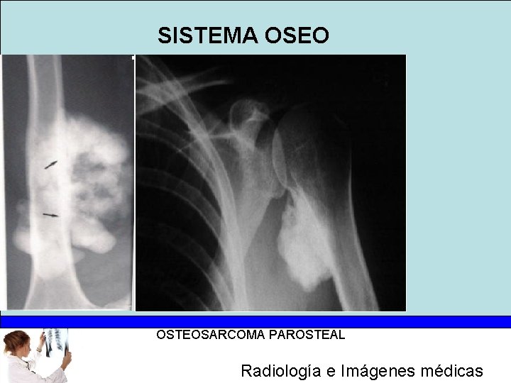 SISTEMA OSEO OSTEOSARCOMA PAROSTEAL Radiología e Imágenes médicas 