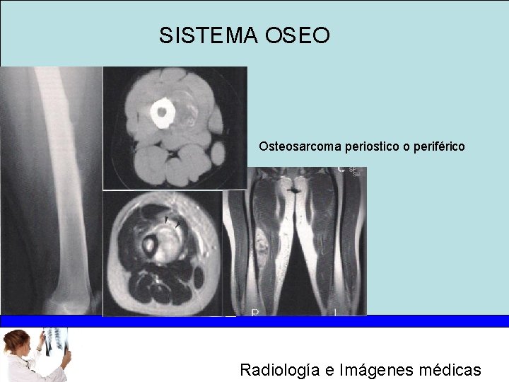 SISTEMA OSEO Osteosarcoma periostico o periférico Radiología e Imágenes médicas 