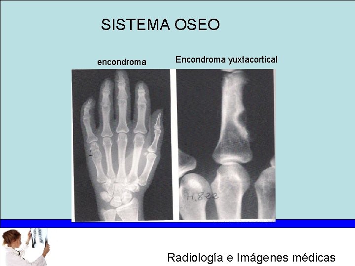 SISTEMA OSEO encondroma Encondroma yuxtacortical Radiología e Imágenes médicas 