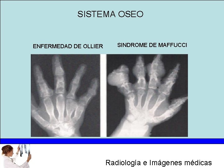 SISTEMA OSEO ENFERMEDAD DE OLLIER SINDROME DE MAFFUCCI Radiología e Imágenes médicas 