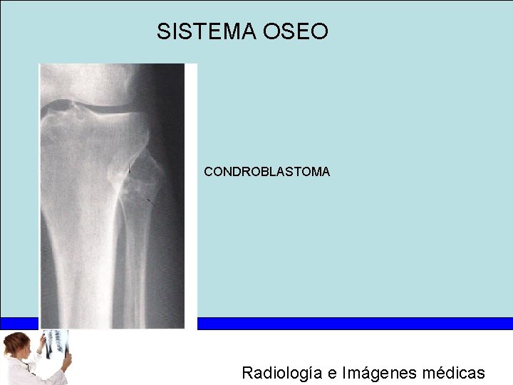 SISTEMA OSEO CONDROBLASTOMA Radiología e Imágenes médicas 