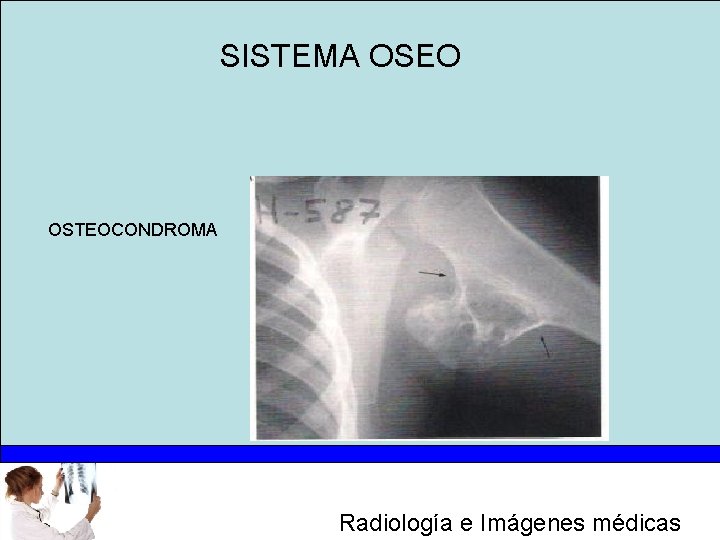 SISTEMA OSEO OSTEOCONDROMA Radiología e Imágenes médicas 