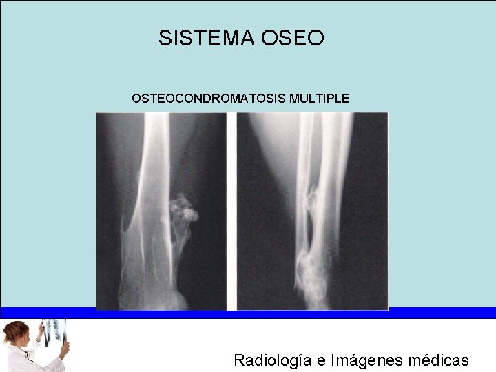 SISTEMA OSEO OSTEOCONDROMATOSIS MULTIPLE Radiología e Imágenes médicas 