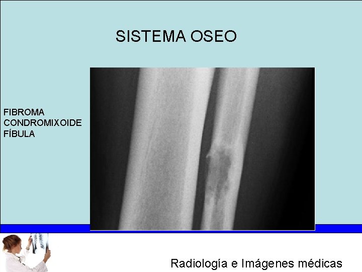 SISTEMA OSEO anular FIBROMA CONDROMIXOIDE FÍBULA Radiología e Imágenes médicas 