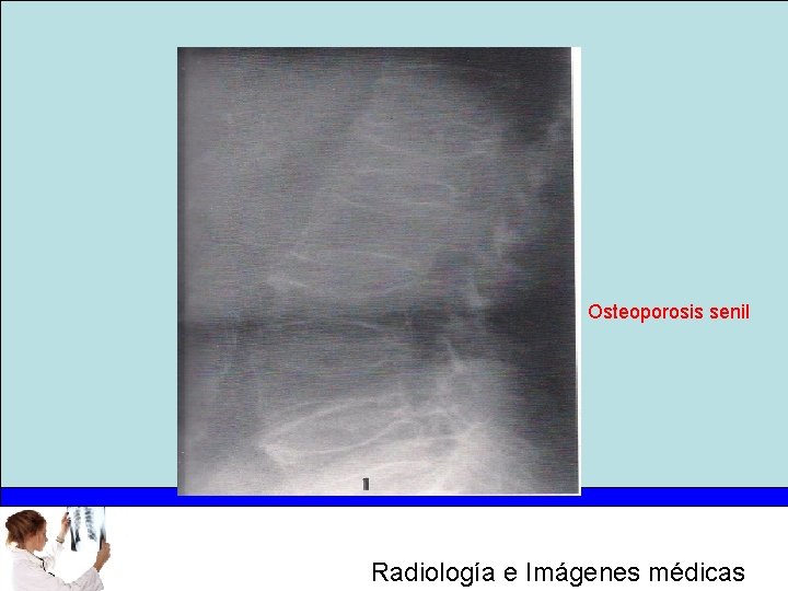 Osteoporosis senil Radiología e Imágenes médicas 