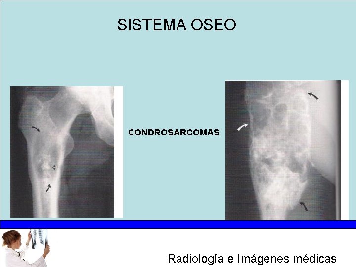 SISTEMA OSEO CONDROSARCOMAS Radiología e Imágenes médicas 
