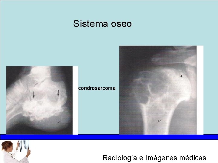 Sistema oseo condrosarcoma Radiología e Imágenes médicas 