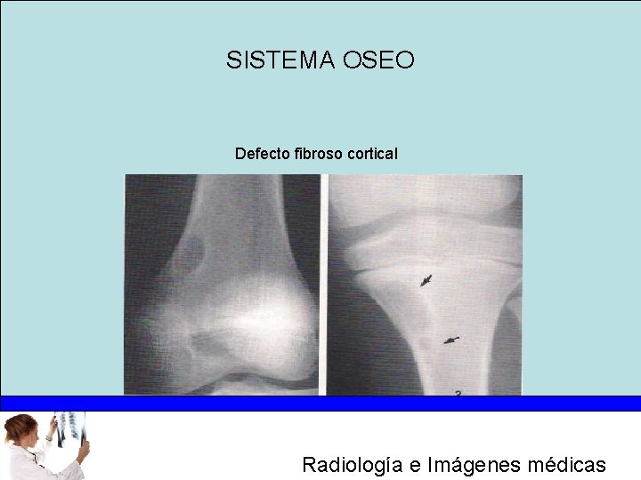 SISTEMA OSEO Defecto fibroso cortical Radiología e Imágenes médicas 