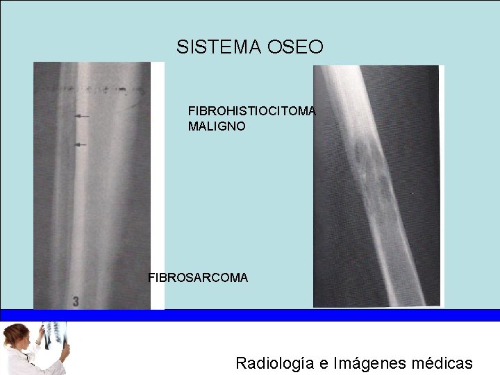 SISTEMA OSEO FIBROHISTIOCITOMA MALIGNO FIBROSARCOMA Radiología e Imágenes médicas 
