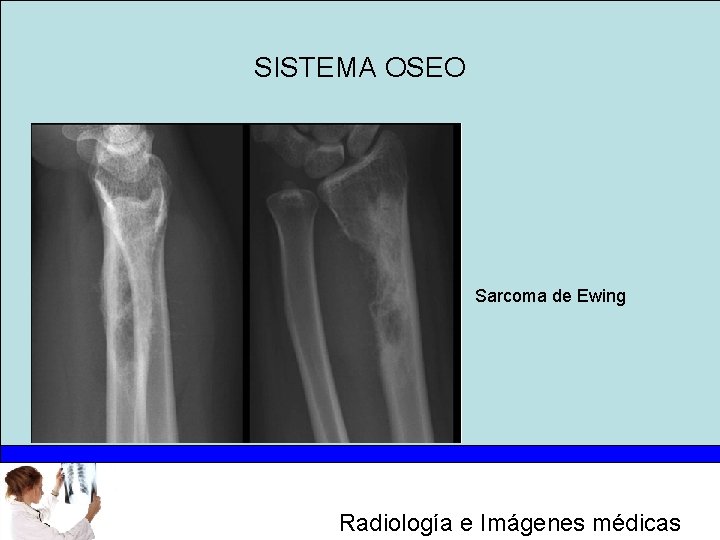 SISTEMA OSEO Sarcoma de Ewing Radiología e Imágenes médicas 