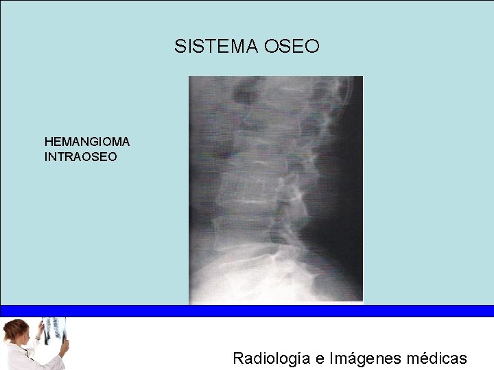 SISTEMA OSEO HEMANGIOMA INTRAOSEO Radiología e Imágenes médicas 