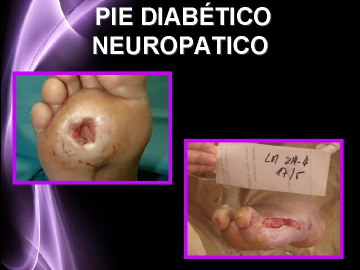 PIE DIABÉTICO NEUROPATICO 