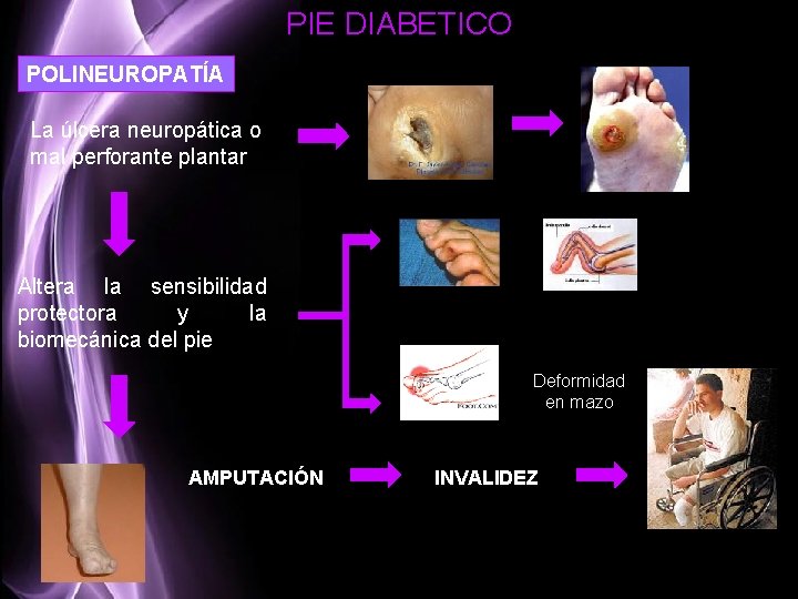 PIE DIABETICO POLINEUROPATÍA La úlcera neuropática o mal perforante plantar Altera la sensibilidad protectora