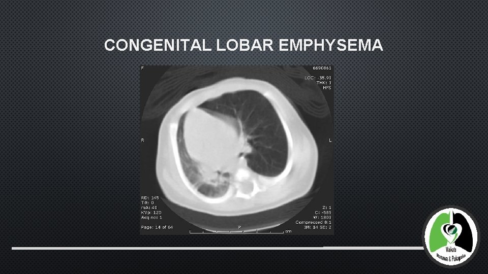 CONGENITAL LOBAR EMPHYSEMA 