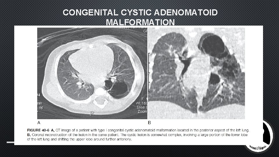 CONGENITAL CYSTIC ADENOMATOID MALFORMATION 