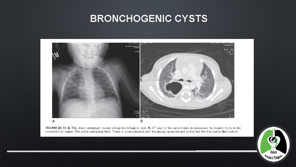 BRONCHOGENIC CYSTS 