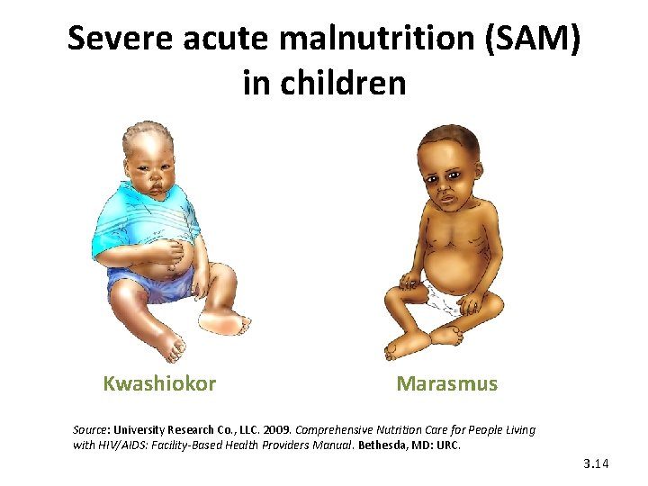 Severe acute malnutrition (SAM) in children Kwashiokor Marasmus Source: University Research Co. , LLC.