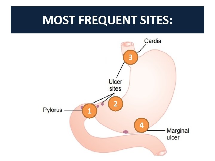 MOST FREQUENT SITES: 3 1 2 4 