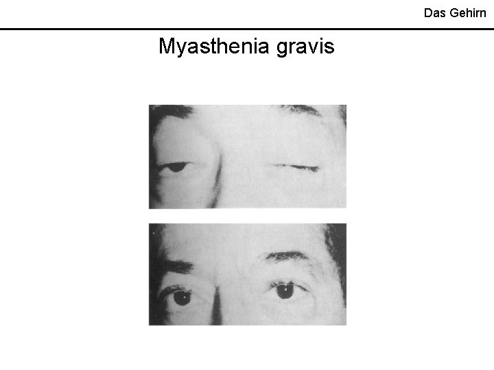 Das Gehirn Myasthenia gravis 